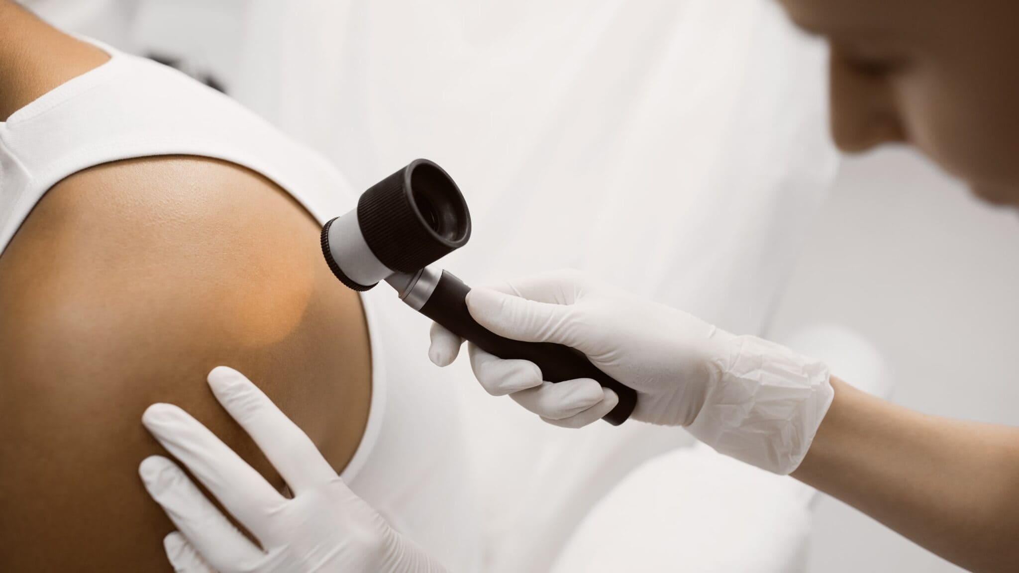 A medical professional wearing gloves examining a patient's skin on their shoulder with a dermatoscope in a clinical setting.
